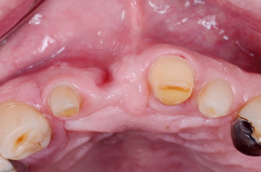 歯肉増大術