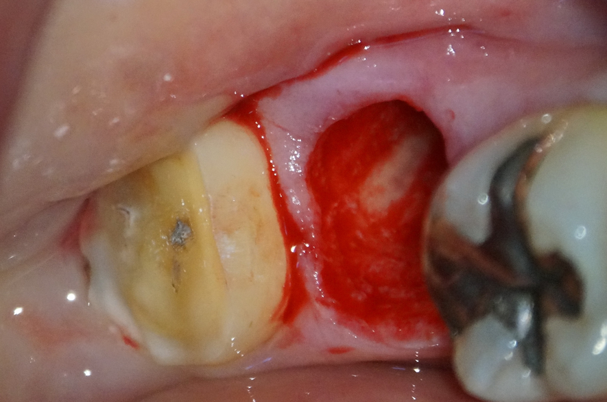 歯の移植（自家歯牙移植）