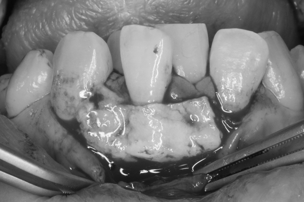 失われた歯肉の再生