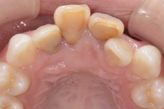前歯部インプラント症例（抜歯即時埋入即時荷重）