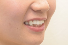 前歯部インプラント症例（抜歯即時埋入即時荷重）