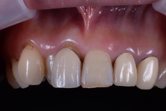 歯周外科処置とジルコニアクラウン＆べニア症例