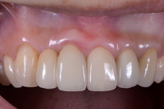 歯周外科処置とジルコニアクラウン＆べニア症例