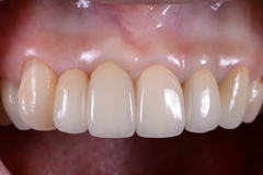 歯周外科処置とジルコニアクラウン＆べニア症例