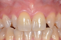 矮小歯をラミネートベニアで修復したセラミック治療症例