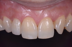 矮小歯をラミネートベニアで修復したセラミック治療治療症例