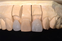 ラミネートベニアで歯並びを改善した症例