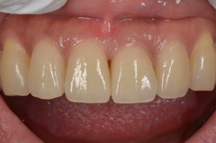前歯部をオールセラミックスで修復したセラミック治療症例
