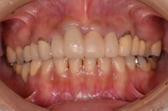 歯肉整形手術を併用して、セラミック的な歯肉ライン創り上げたセラミック治療症例