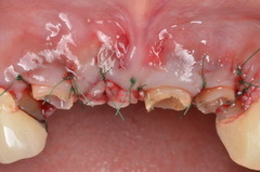 歯肉整形手術を併用して、セラミック的な歯肉ライン創り上げたセラミック治療治療症例