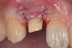 矯正治療と外科治を併用して破折した歯を保存したセラミック治療症例