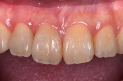 矯正治療と外科治を併用して破折した歯を保存したセラミック治療症例