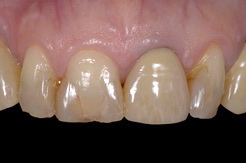 オールセラミックスとラミネートベニアを使用した前歯6本のセラミック修復