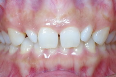 ラミネートベニアで前歯の空隙を治療したセラミック治療治療症例