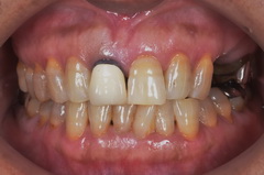 金属アレルギー患者にジルコニアを使用した全顎的セラミック治療例