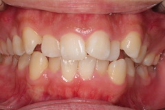 矯正治療と外科治を併用して破折した歯を保存した治療症例