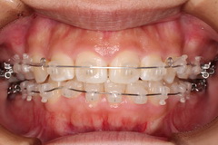 矯正治療と外科治を併用して破折した歯を保存した療症例