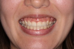 矯正治療と外科治療を併用して破折した歯を保存した治療症例