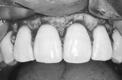 矯正治療と外科治を併用して破折した歯を保存し症例