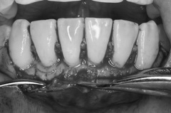 矯正治療と外科治を併用して破折した歯を保存した症例