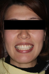 矯正治療と外科治を併用して破折した歯を保存したセラミック治療治療症例