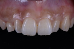 前歯をオールセラミッククラウンで治療したセラミック治療症例
