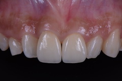 前歯をオールセラミッククラウンで治療したセラミック治療症例